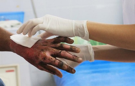 Habitante de Dosquebradas que sufrió quemaduras por pólvora siendo atendido por una enfermera de la Secretaría de Salud de Dosquebradas